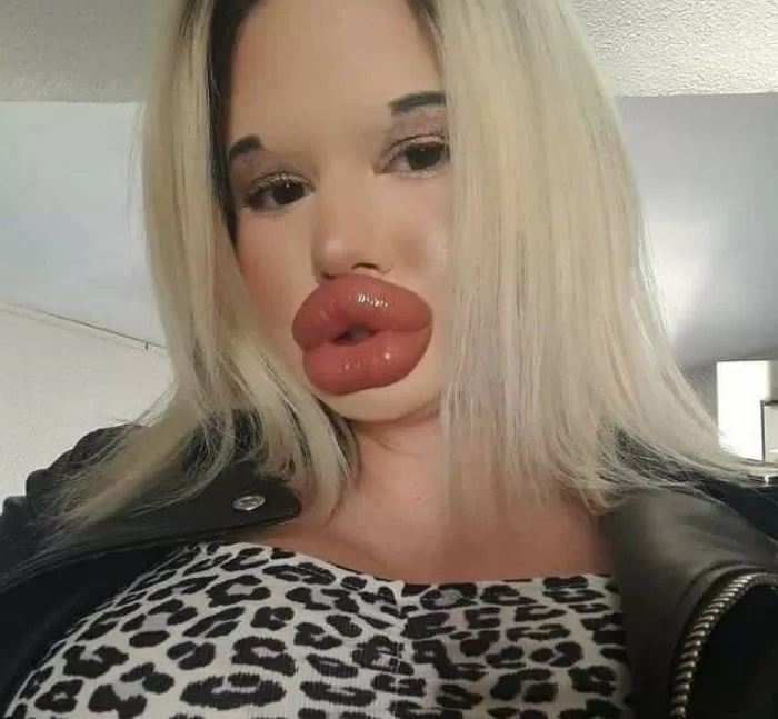 【閲覧注意】「セクシーな唇が欲しい」と25回も整形を繰り返した女性　とんでもない唇になってしまう