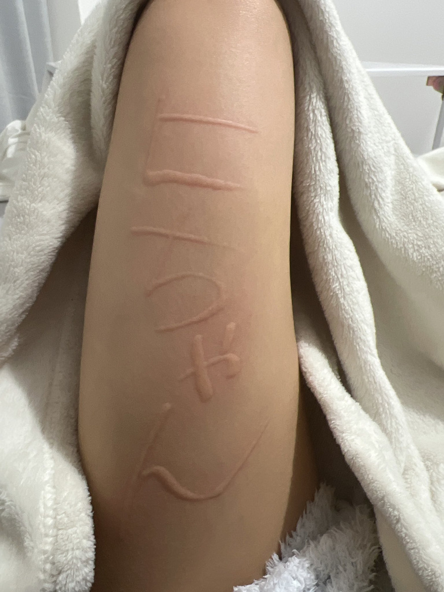 【画像】アイドルさん、皮膚を触ると蕁麻疹が出るからと太ももをなぞって文字を書いてしまう